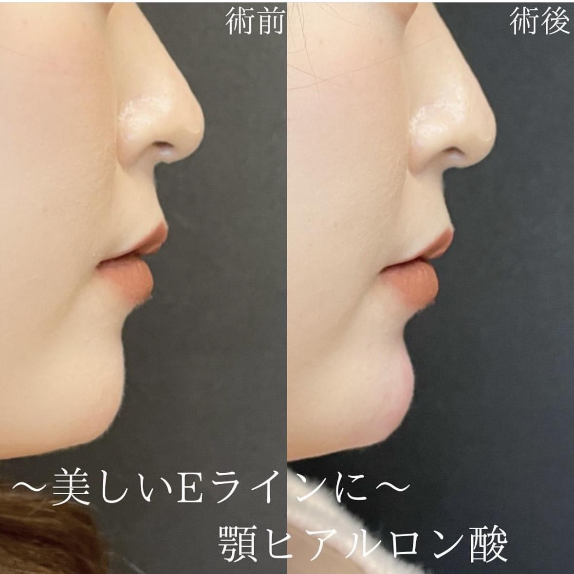 玻尿酸填充