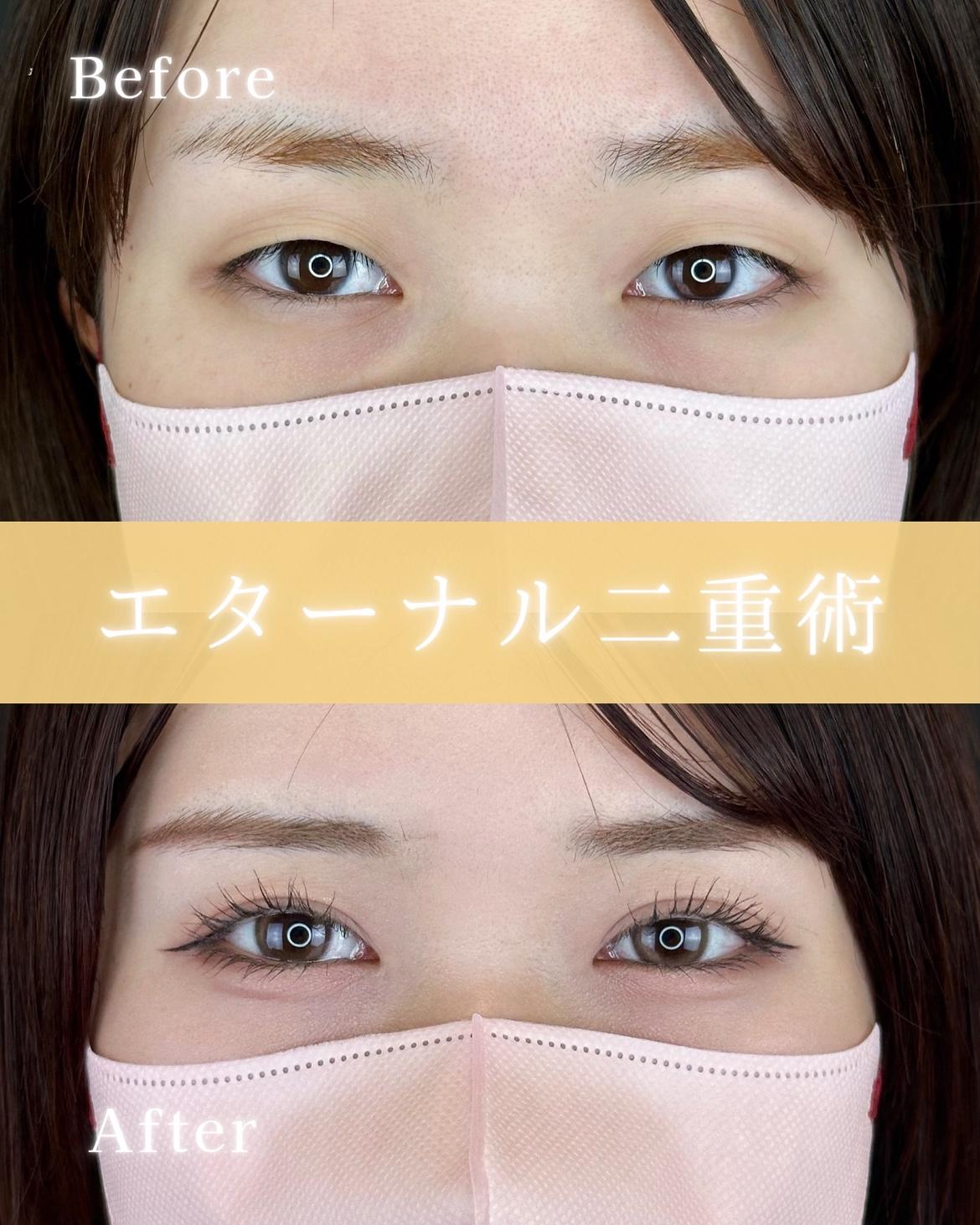 双眼皮手术