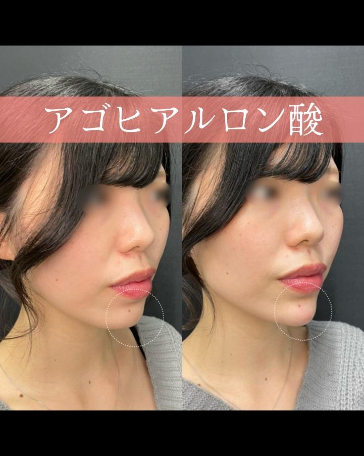 玻尿酸填充