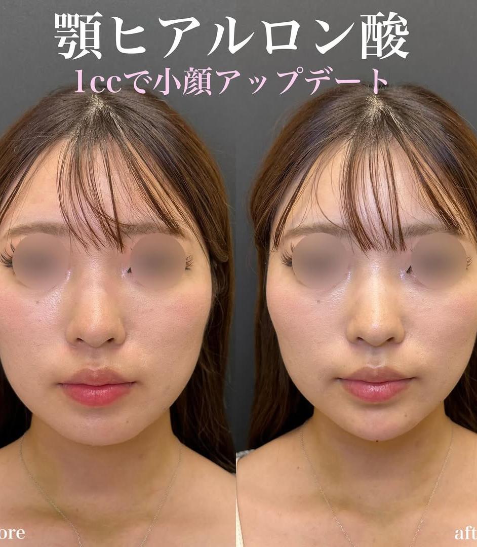 玻尿酸填充