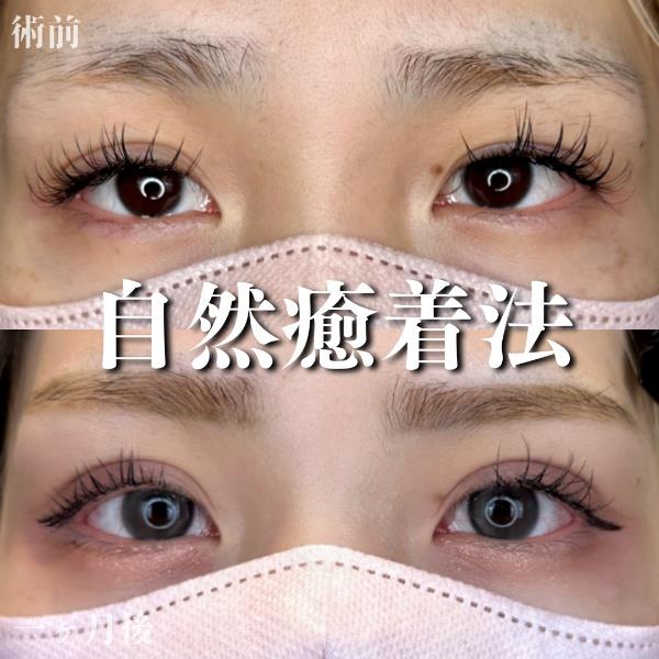 双眼皮手术