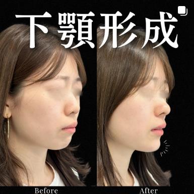 玻尿酸填充