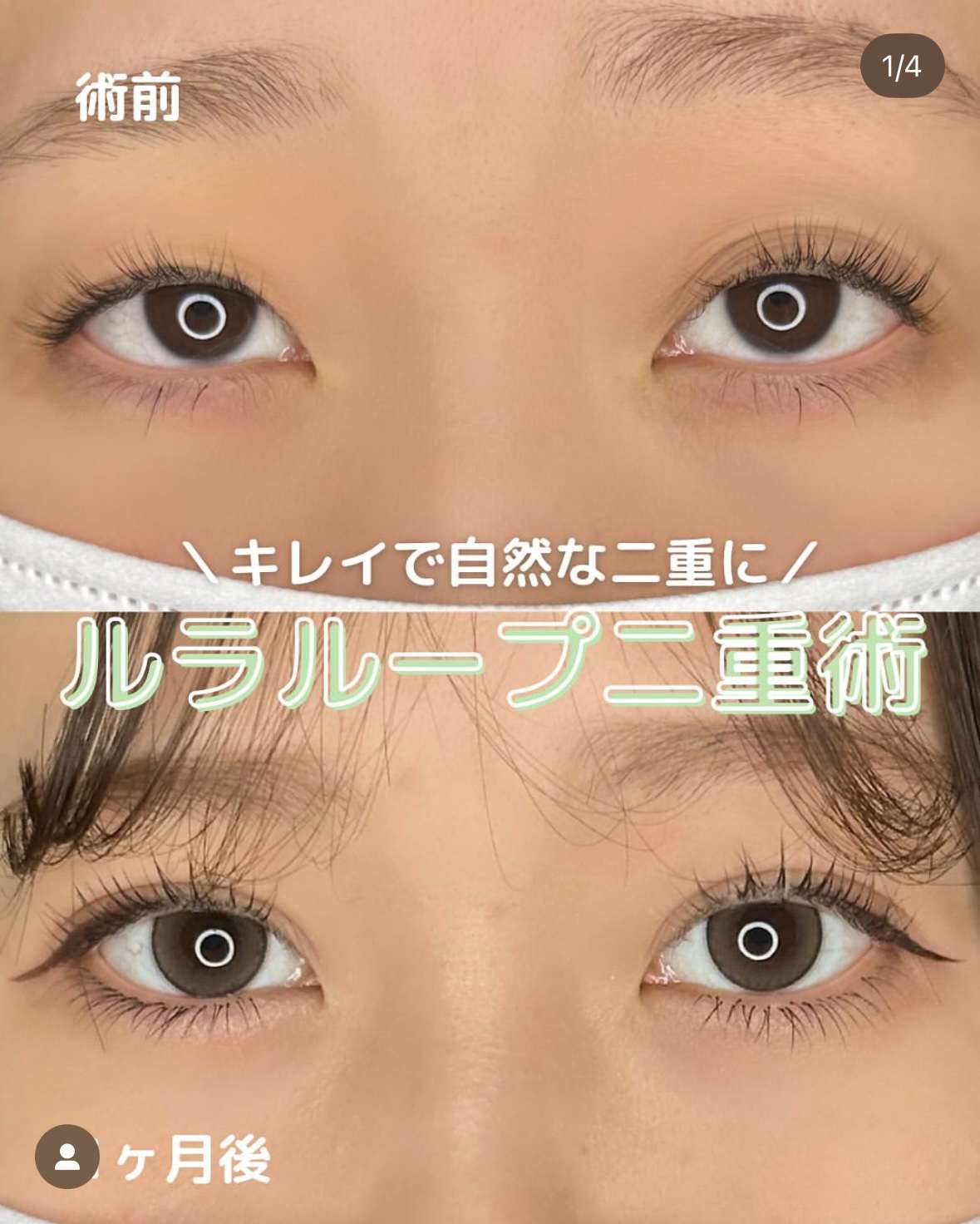双眼皮手术