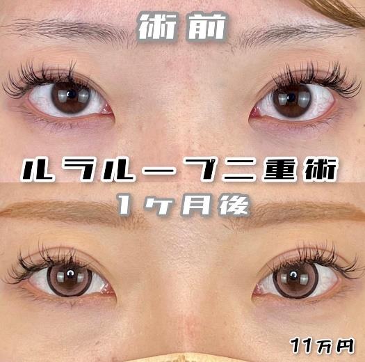 双眼皮手术