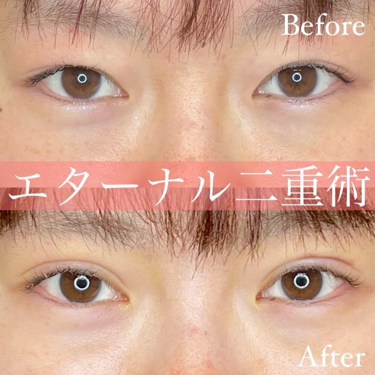 双眼皮手术