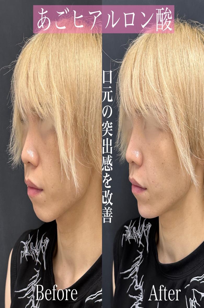 玻尿酸填充