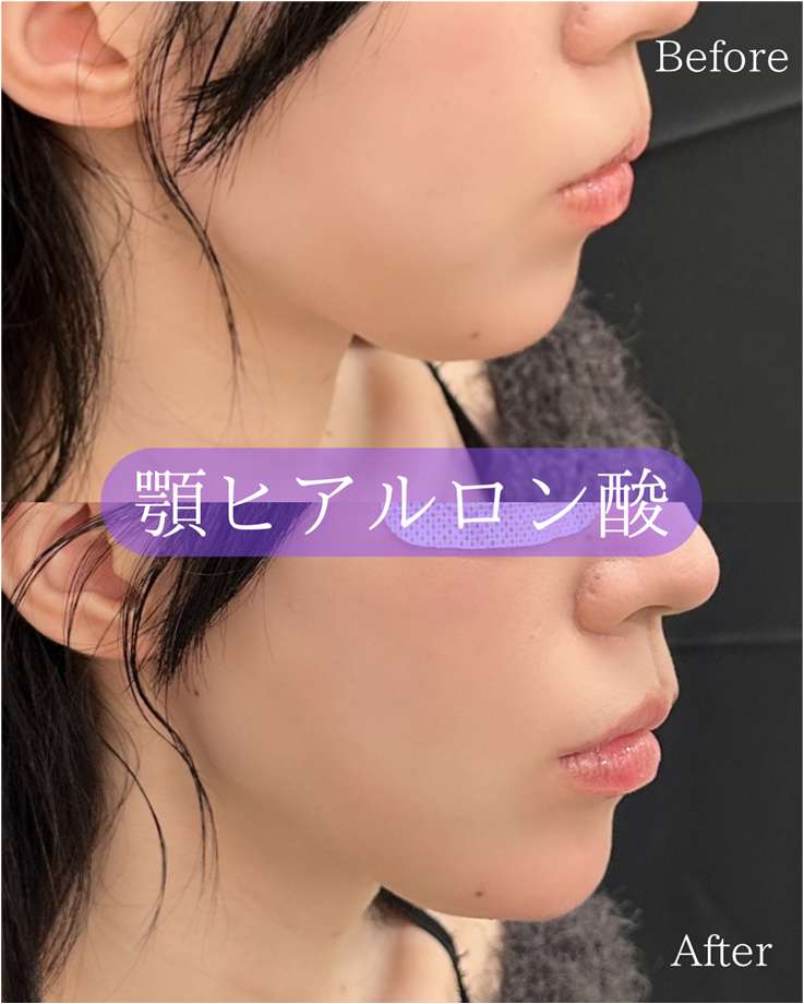 玻尿酸填充