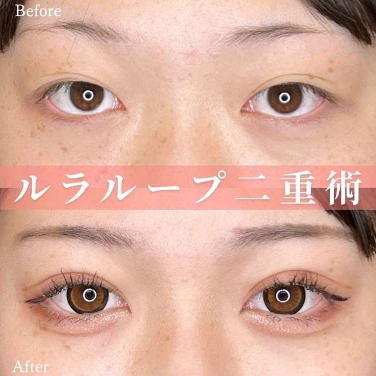 双眼皮手术