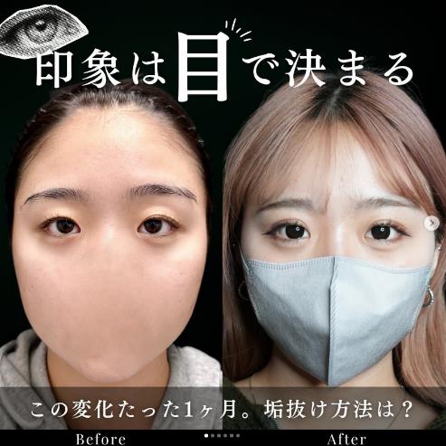 双眼皮手术