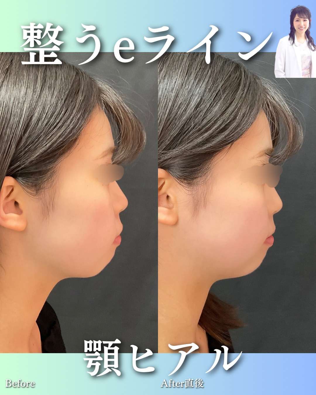 玻尿酸填充