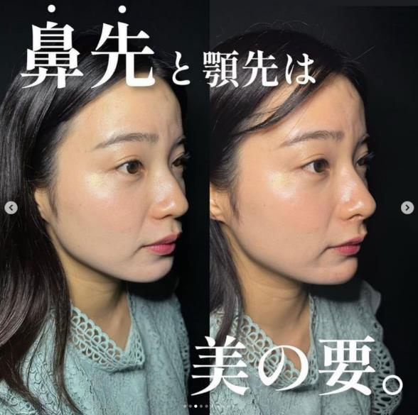 玻尿酸填充
