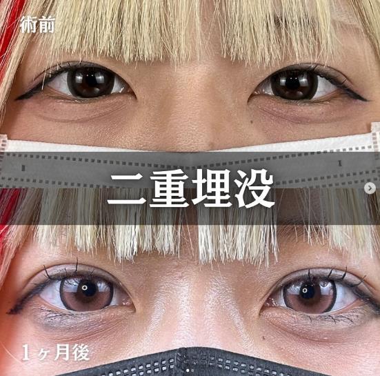双眼皮手术