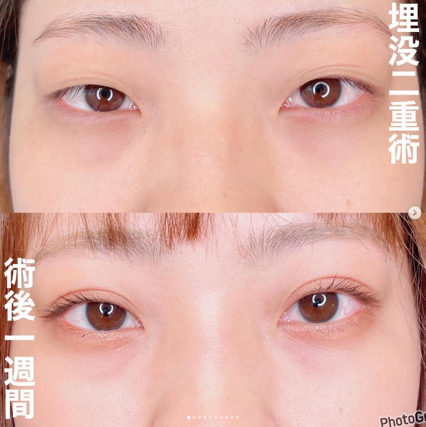双眼皮手术