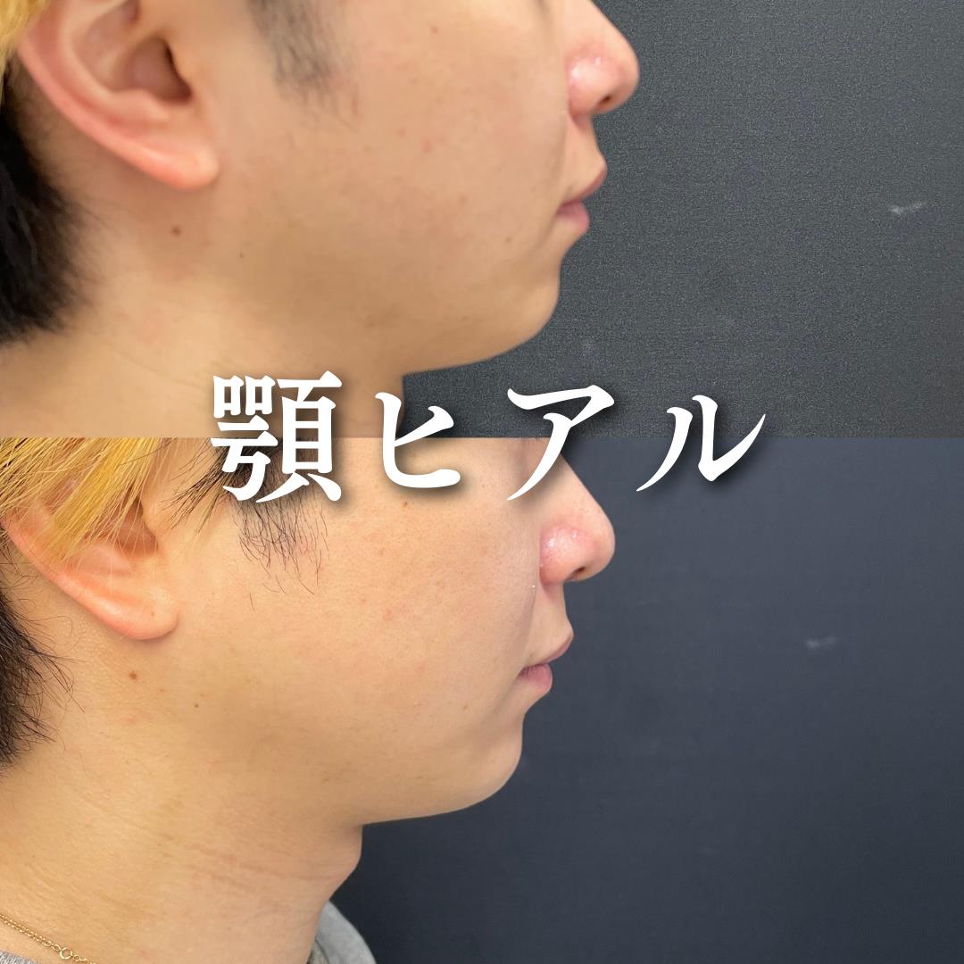 玻尿酸填充