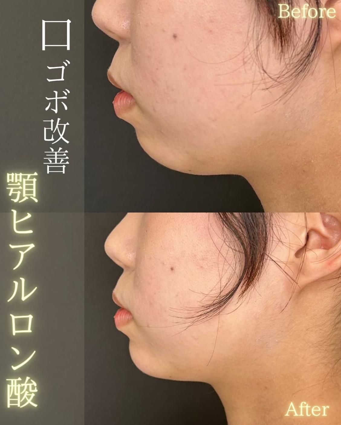 玻尿酸填充