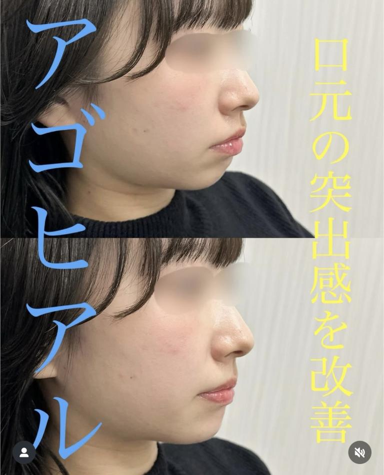 玻尿酸填充