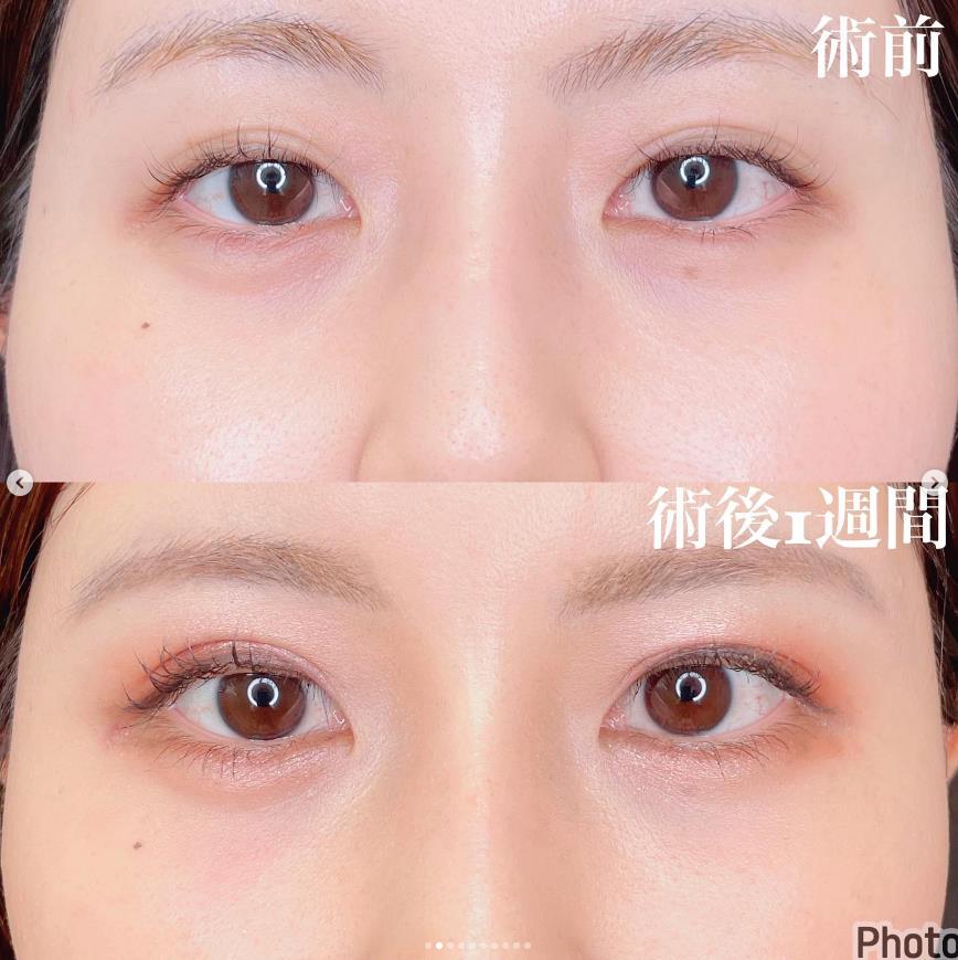 双眼皮手术