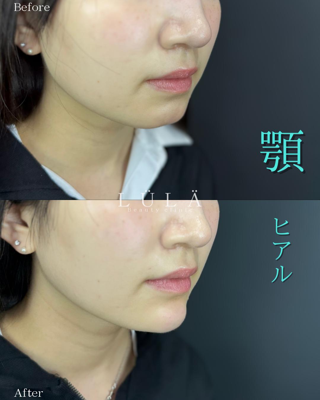 玻尿酸填充