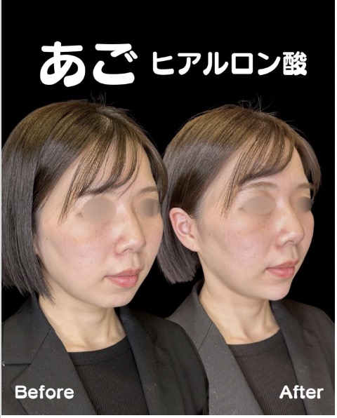 玻尿酸填充