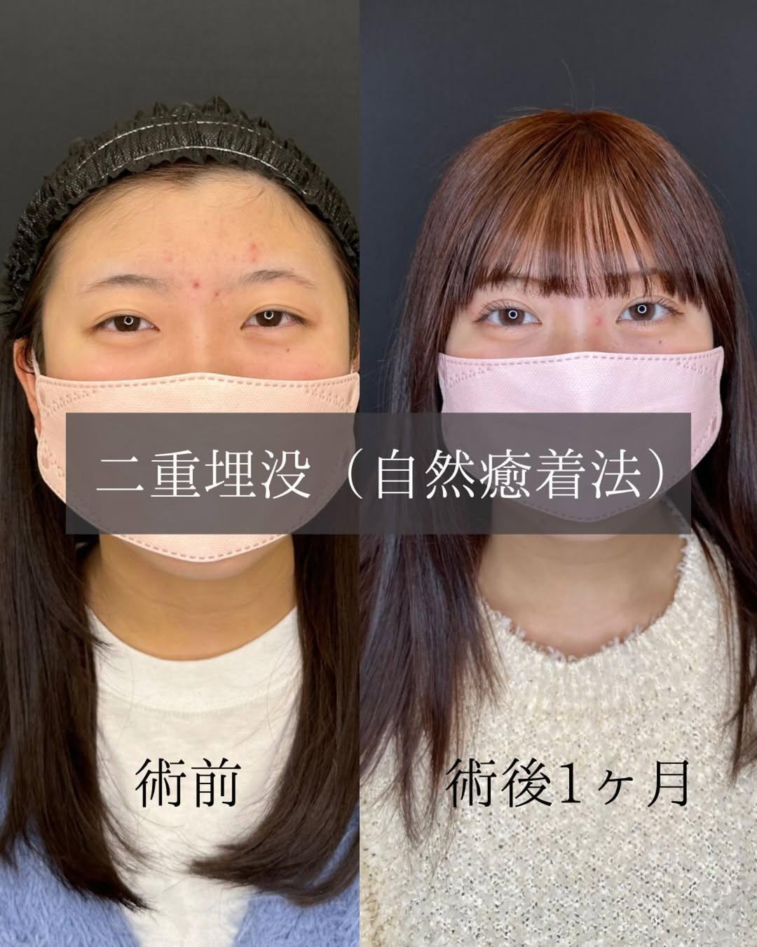 双眼皮手术
