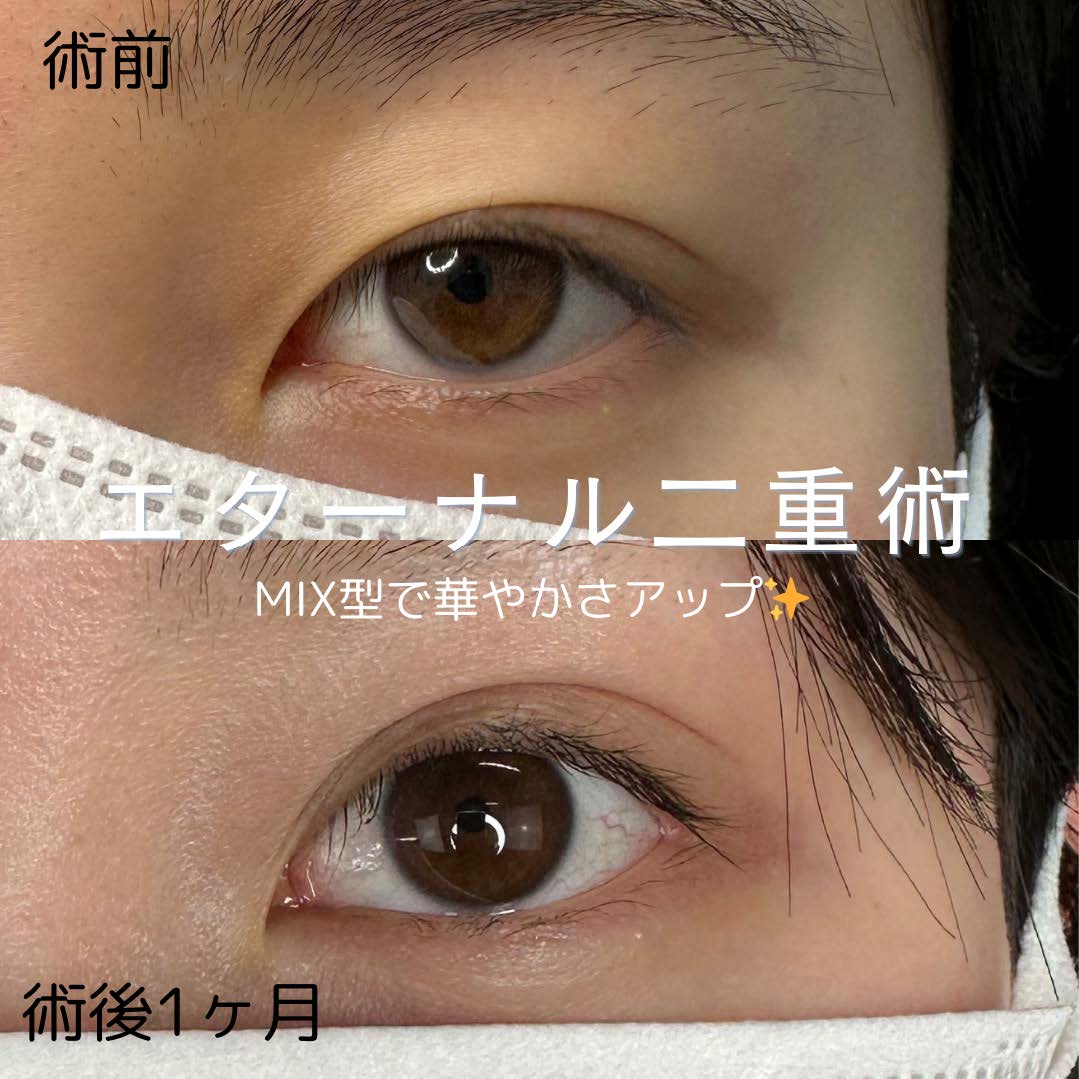 双眼皮手术