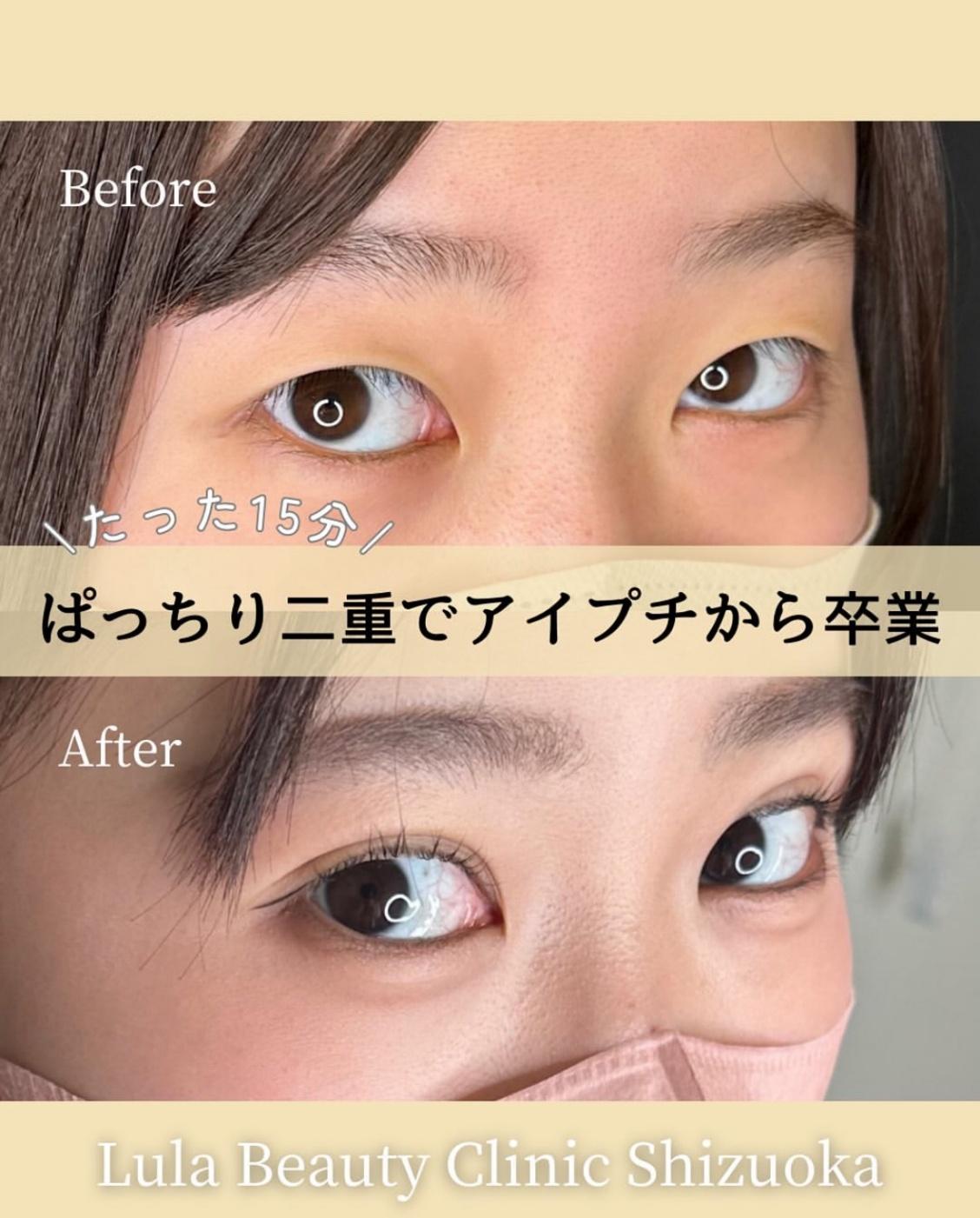 双眼皮手术