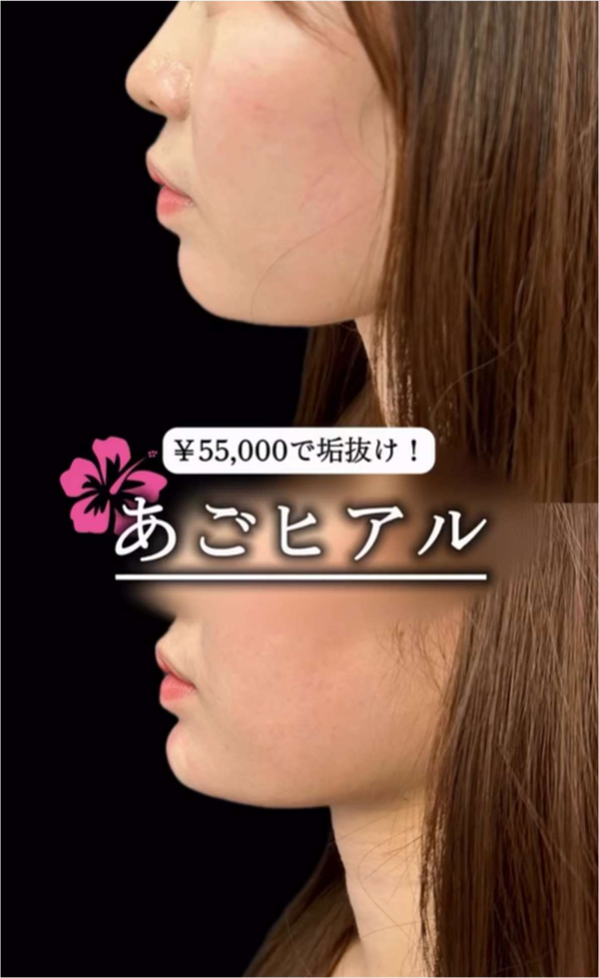 玻尿酸填充