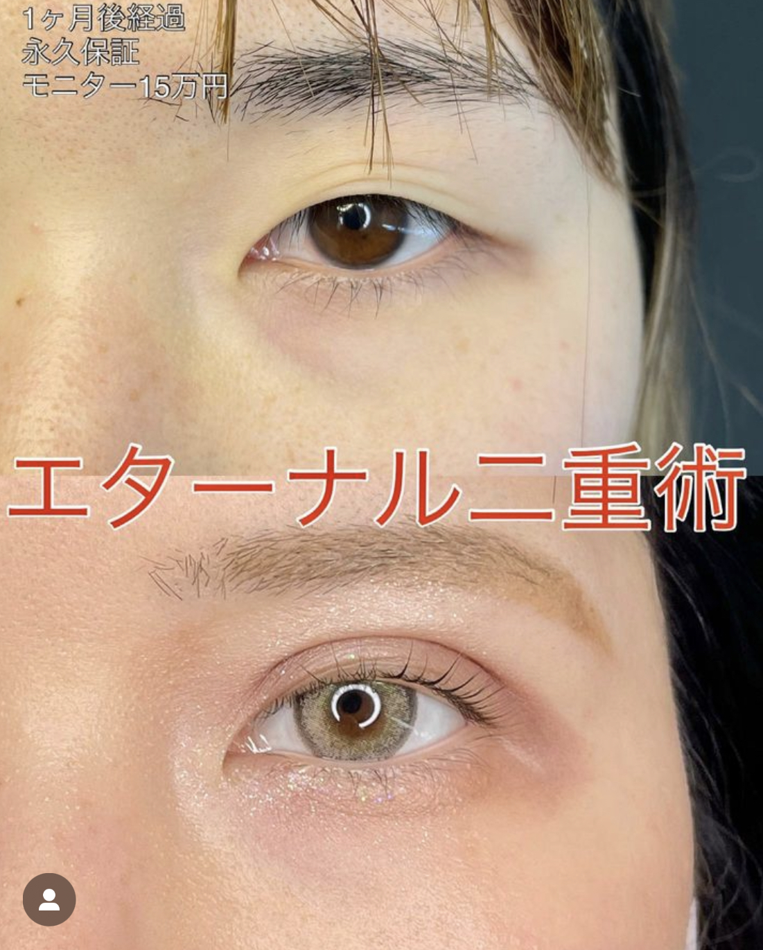 双眼皮手术