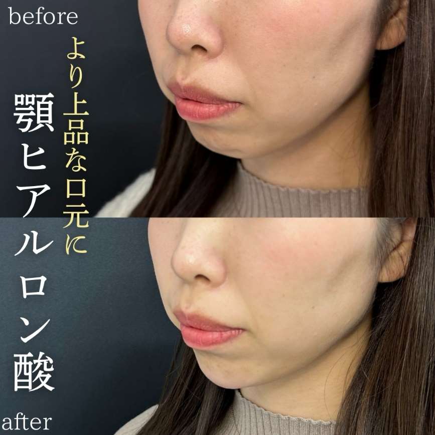玻尿酸填充