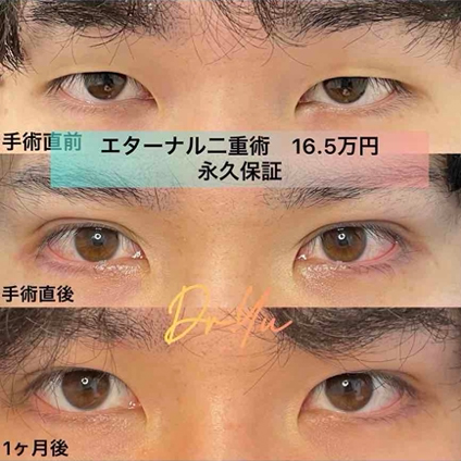 双眼皮手术