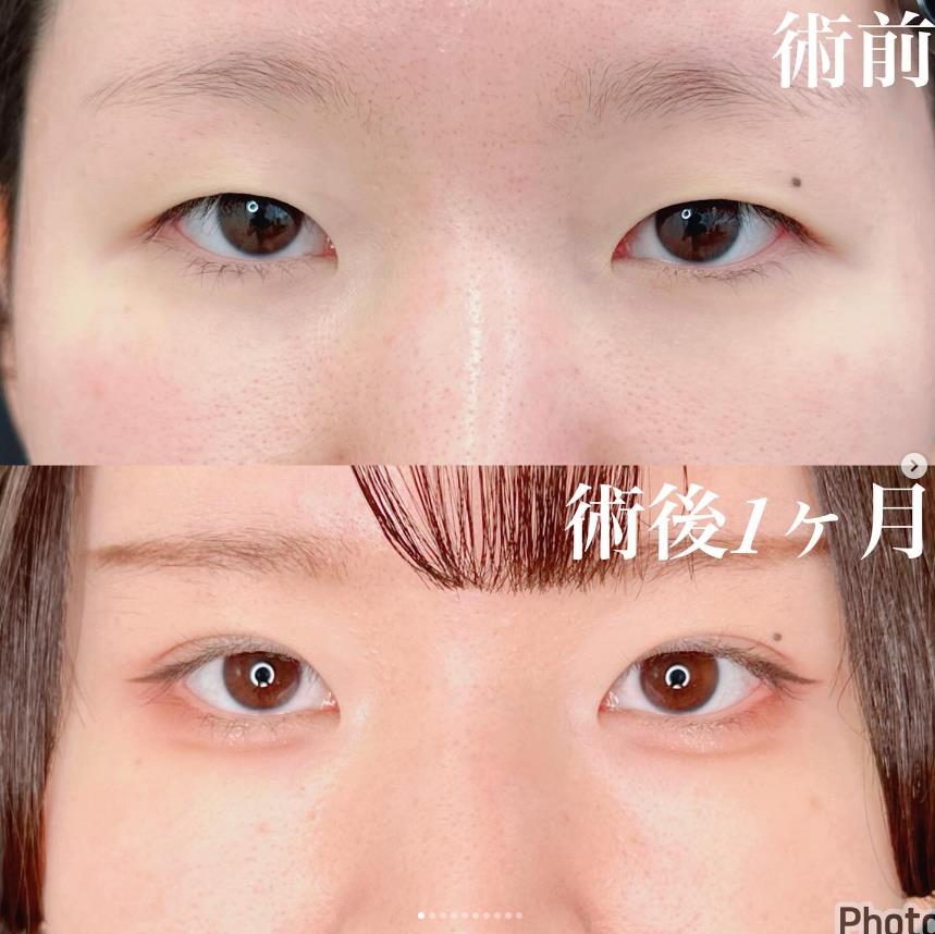 双眼皮手术
