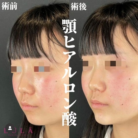玻尿酸填充