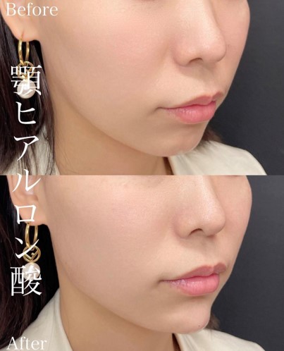 玻尿酸填充