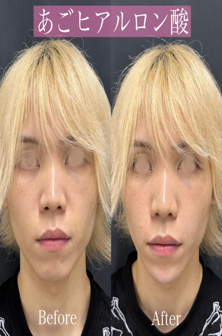玻尿酸填充