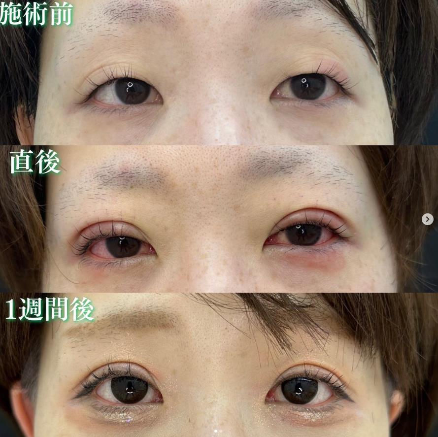 双眼皮手术