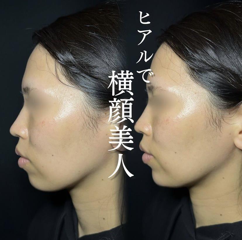 玻尿酸填充