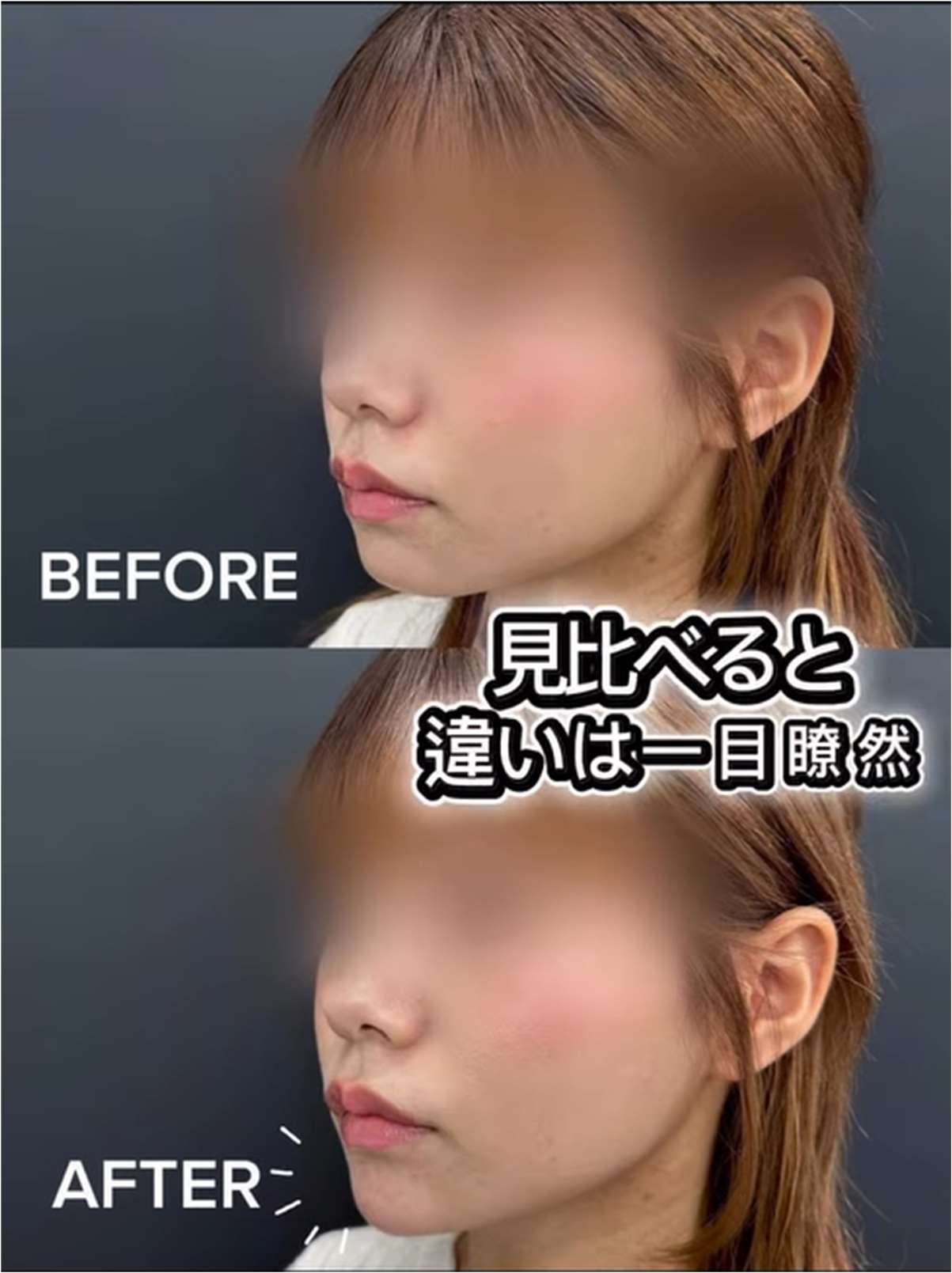 玻尿酸填充