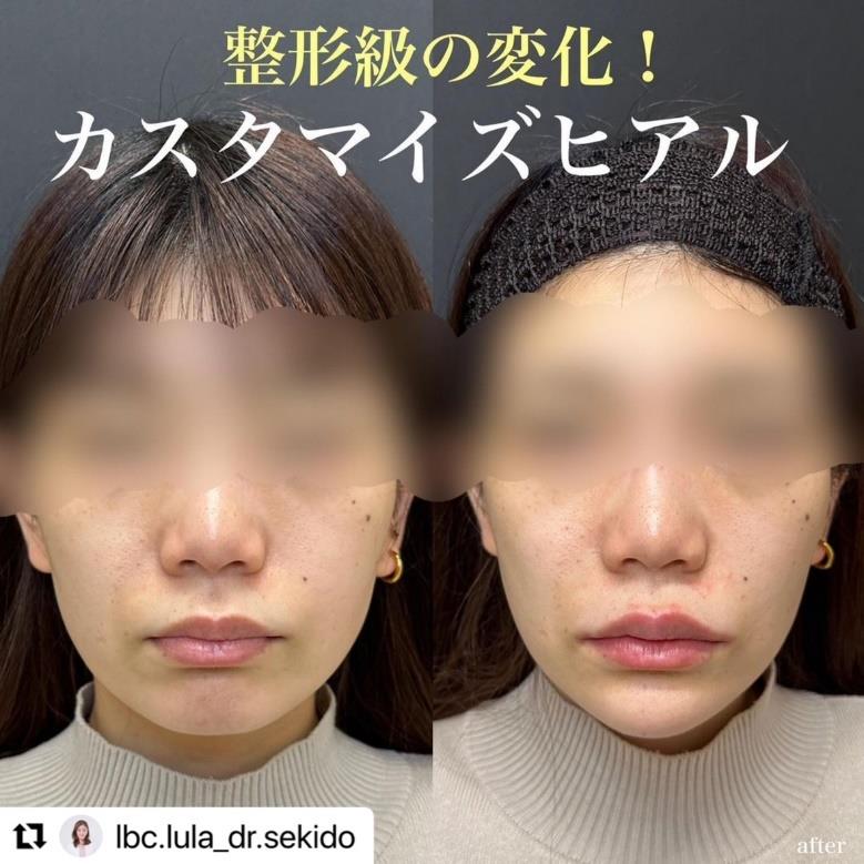 玻尿酸填充