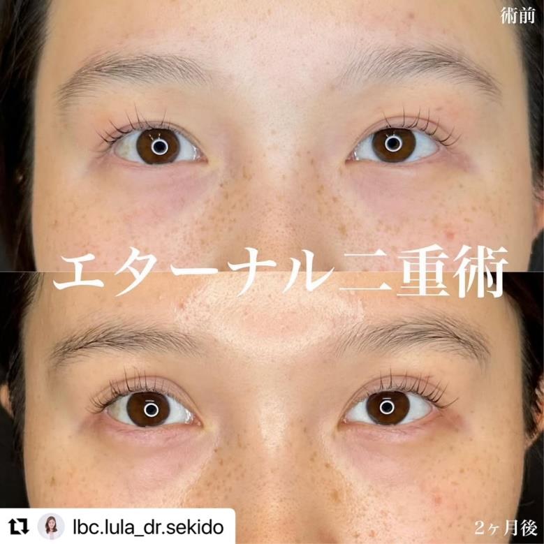 双眼皮手术