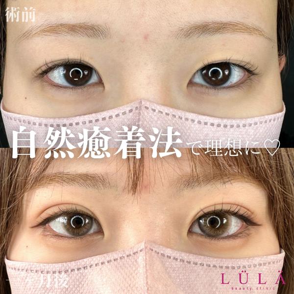 双眼皮手术