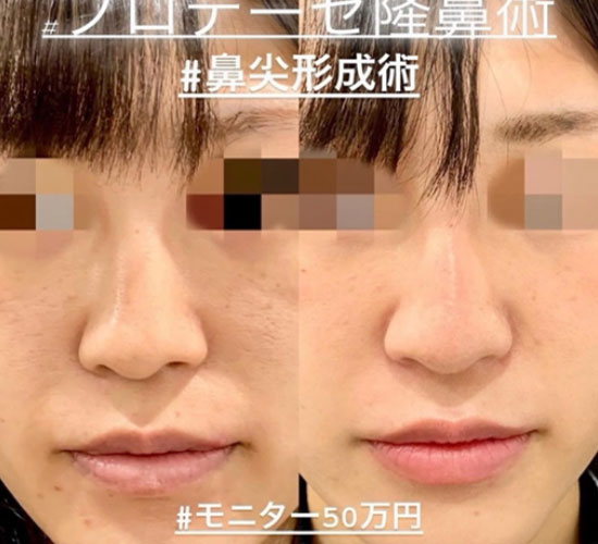 鼻综合整形 + 鼻梁整形 - 硅胶假体 + 鼻尖整形 - 切开法