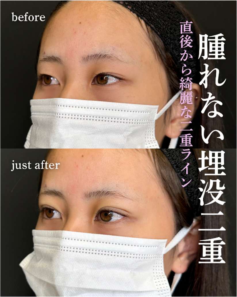 双眼皮手术