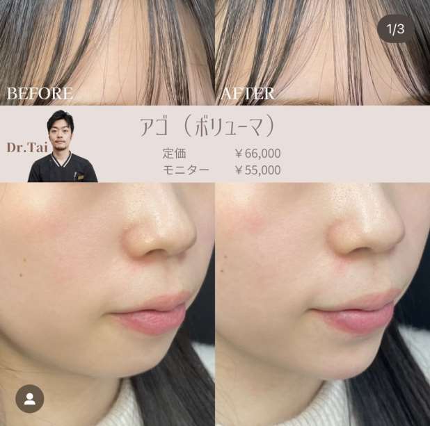 玻尿酸填充