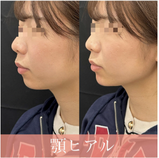 玻尿酸填充