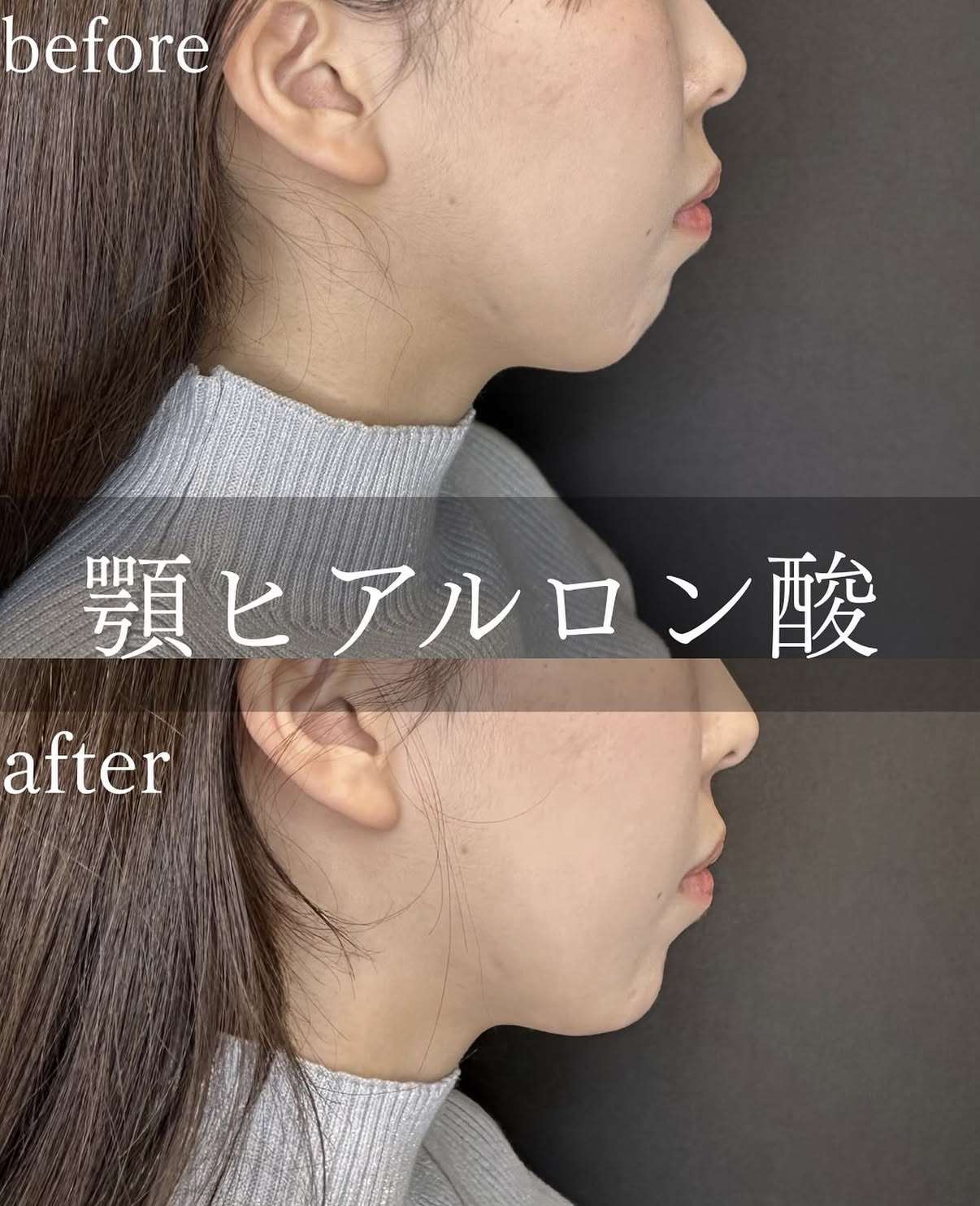 玻尿酸填充