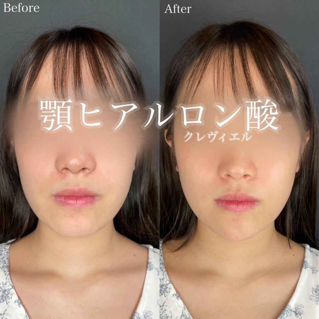 玻尿酸填充