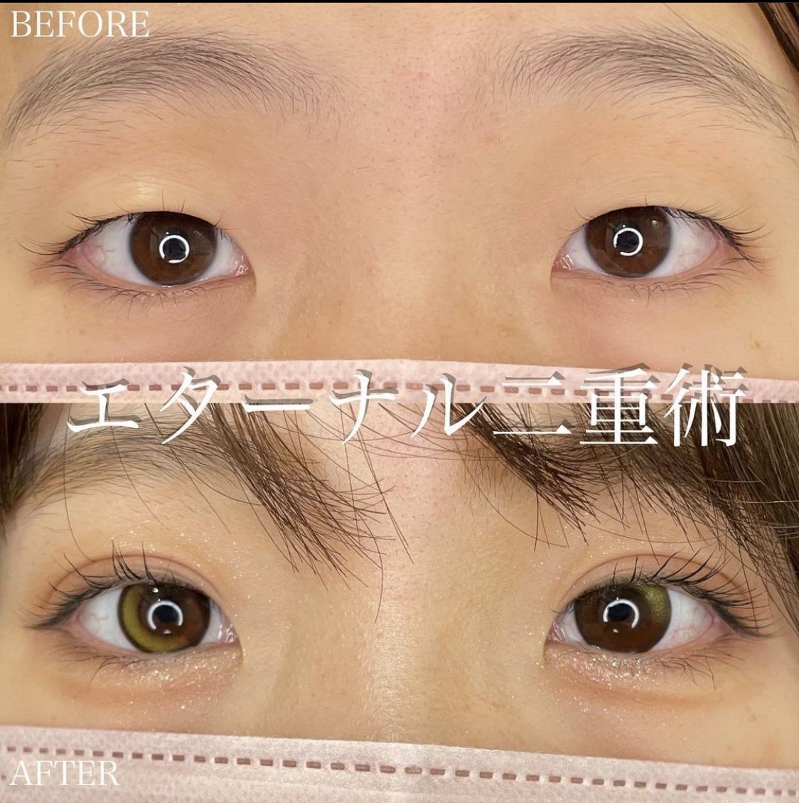 双眼皮手术