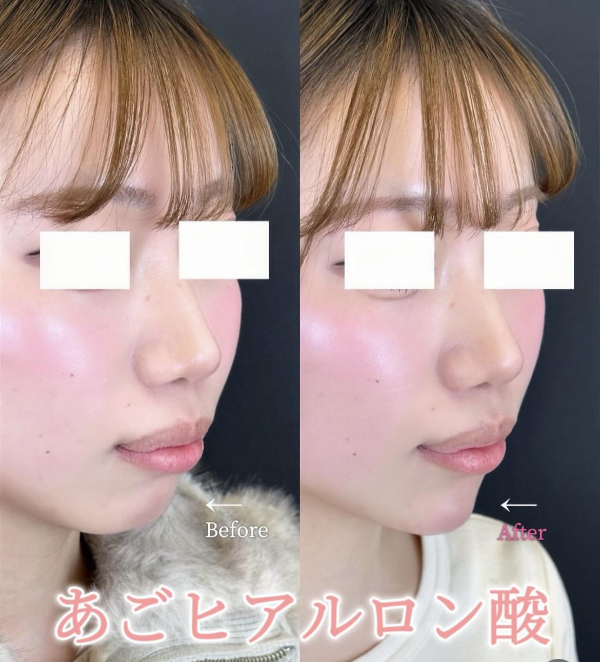 玻尿酸填充