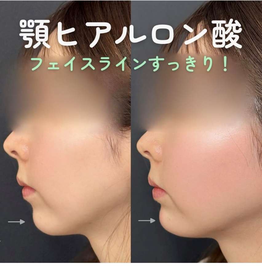 玻尿酸填充