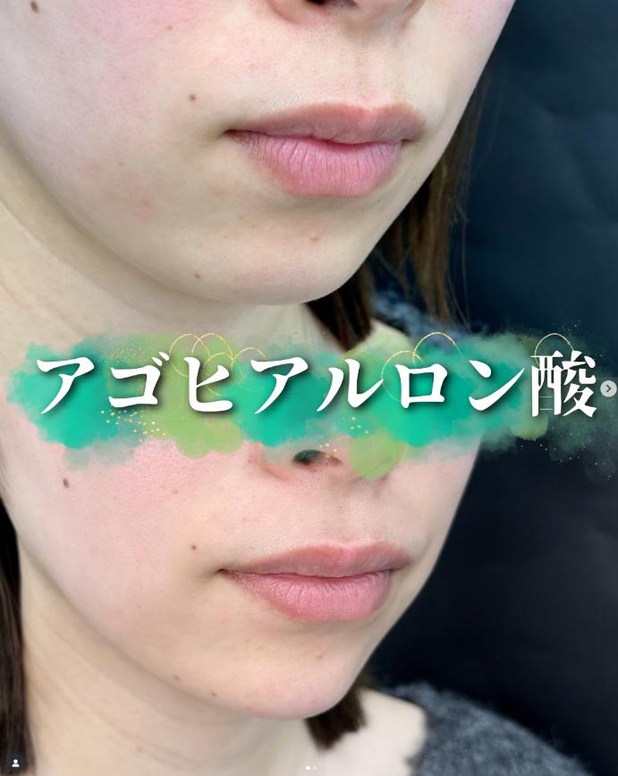 玻尿酸填充